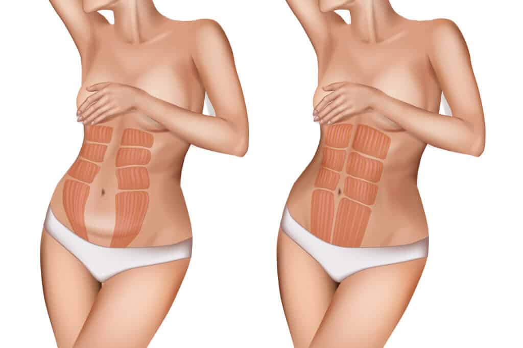 Diástase Abdominal