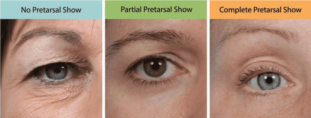 Blefaroplastia superior: o impacto do pré-tarsal show