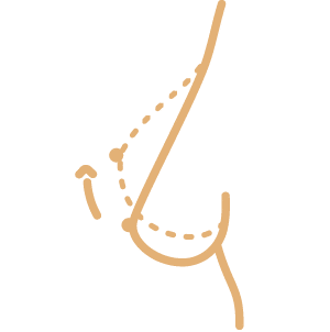 Mamoplastia
